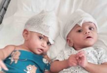 Fijian Conjoined Twins Successfully Separated After Complex Surgery