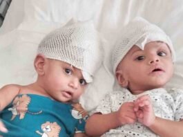 Fijian Conjoined Twins Successfully Separated After Complex Surgery